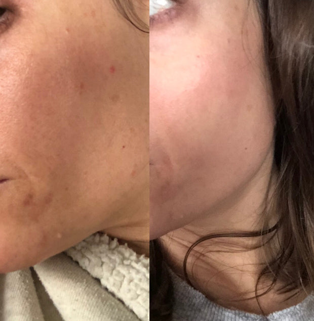 Mi melasma desapareció